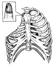 胸廓出口综合症