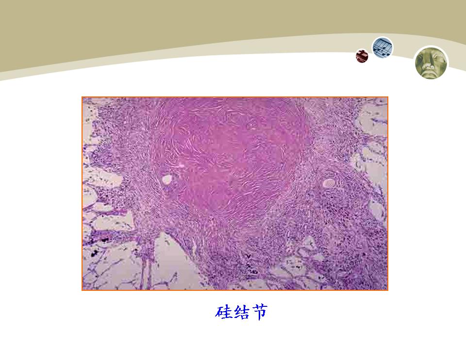  p>肺硅沉着症(silicosis)简称硅肺(亦曾称矽肺),是因长期吸入含大量