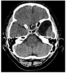 属于先天性良性脑囊肿病变,是由于发育期蛛网膜分裂异常所致