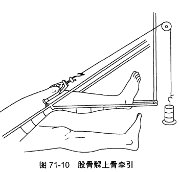 股骨髁上骨牵引