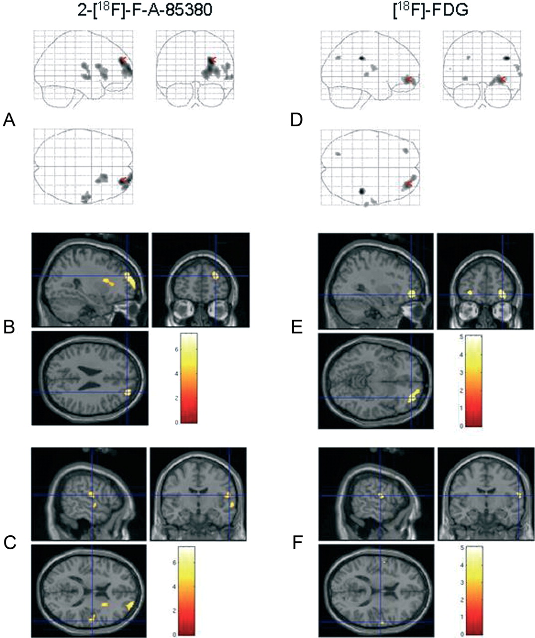 dominant nocturnal frontal lobe epilepsy, andfle),是一种睡眠时