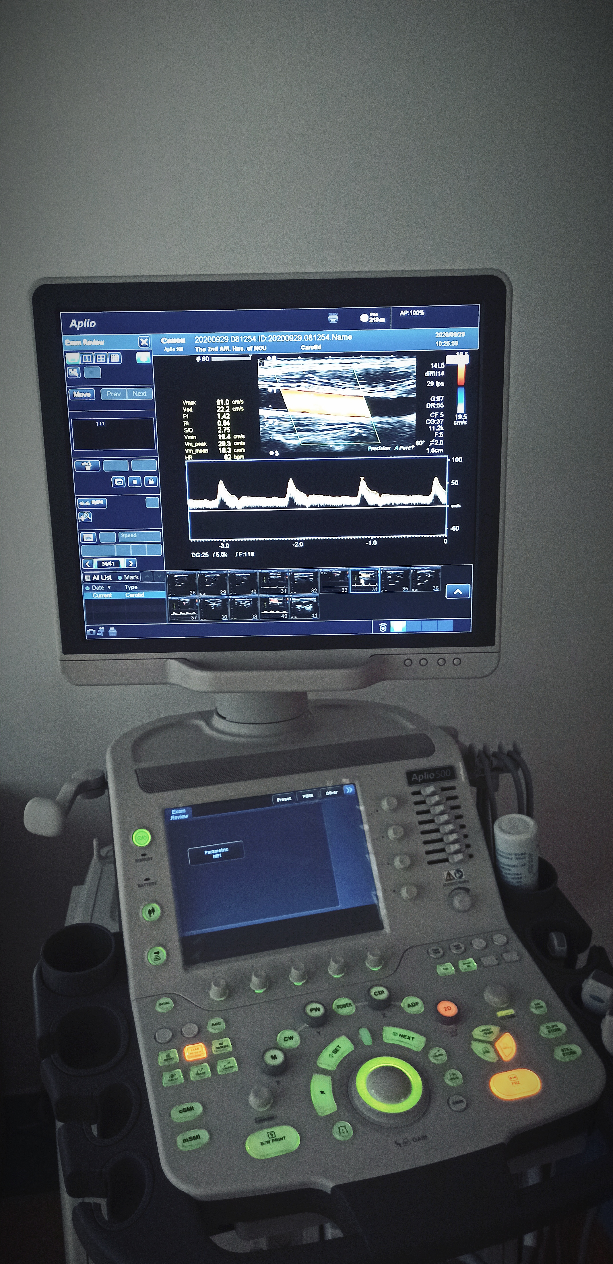 彩色超声多普勒