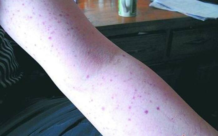  p>急性血小板减少性紫癜是一种病症, a href="#" data-lemmaid="