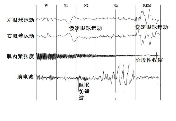  p data-id="gnywocx53x">睡眠纺锤波是睡眠中测试的一种波形,纺锤波