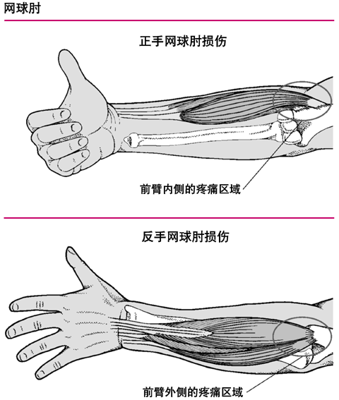  p>肱骨外上髁炎,又名肘外侧疼痛综合症,俗称 a target="_blank" href