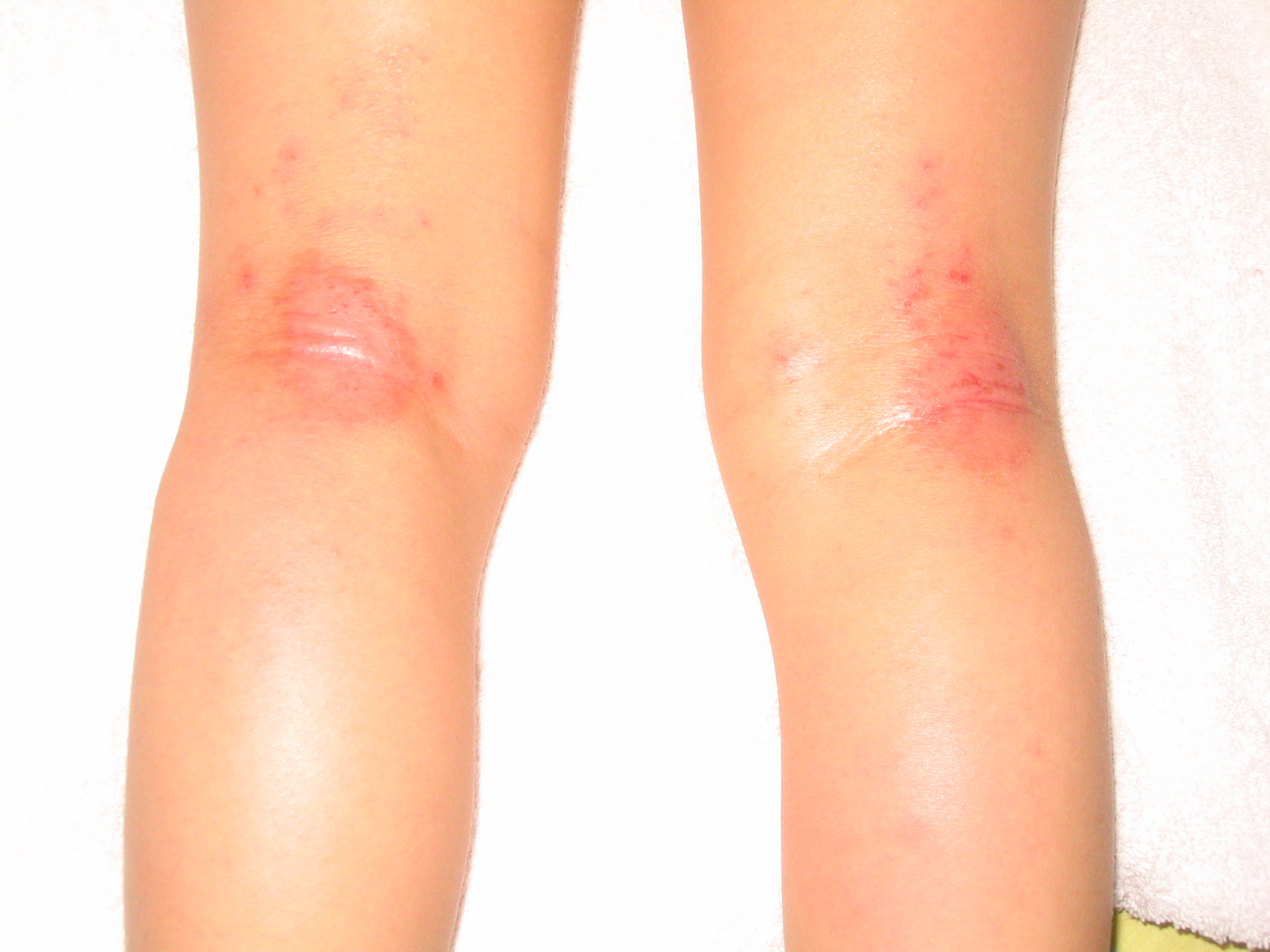 皮肤寄生虫感染