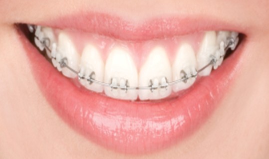  p> b>3m陶瓷自锁托槽 /b>又叫3m陶瓷自锁牙套或3m陶瓷自锁牙箍医学上