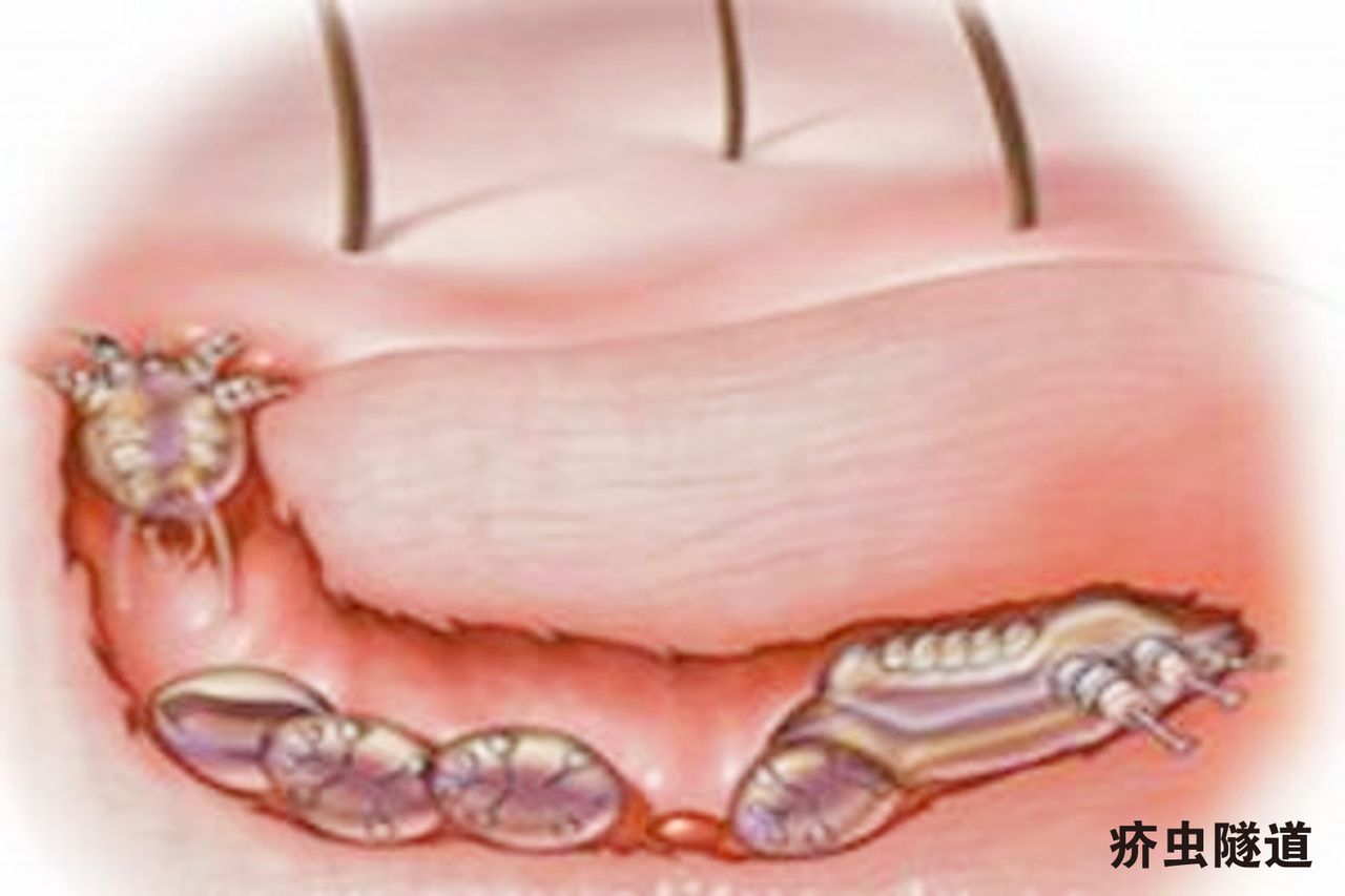  p>在 a target="_blank" href="/item/疥疮/499364" data-lemmaid="