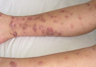 冷球蛋白血症性股臀部皮肤血管炎