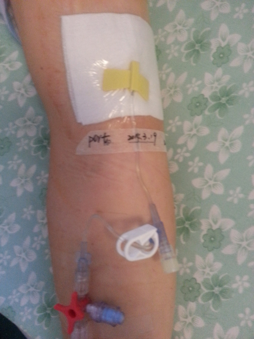  p>植入式静脉输液港是一种完全植入的血管通道系统,它为患者提供长期