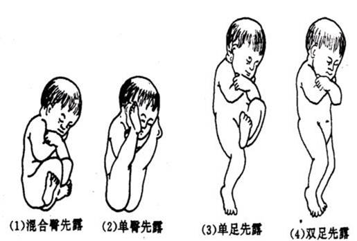 胎先露