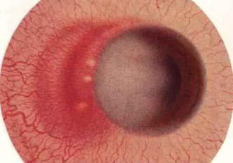 结节性前巩膜炎