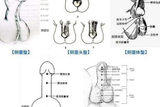 data-lemmaid="1767216">阴茎弯曲 /a>,尿道开口不在正常位置为尿道下
