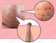 黑头是硬化油脂阻塞物,主要是由皮脂