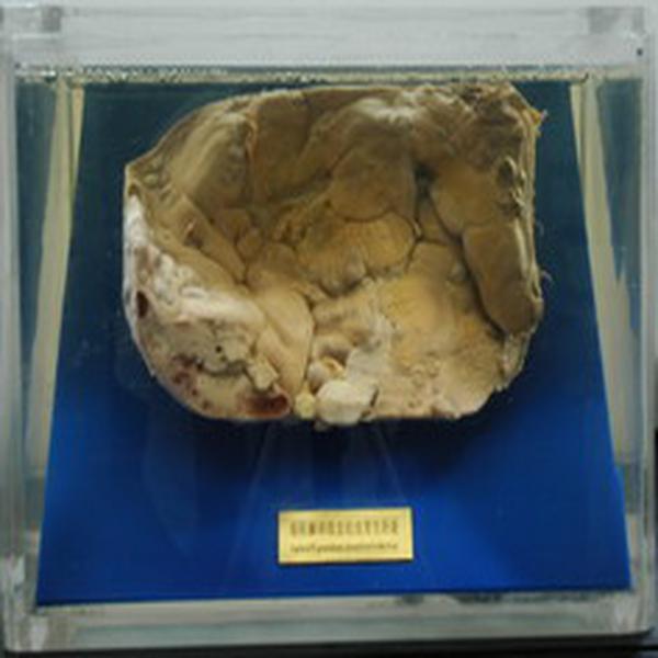 细粒棘球绦虫幼虫