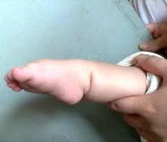 痉挛性截瘫步态