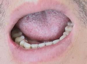 舌无力且不能随意伸缩回旋