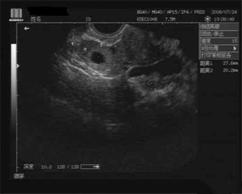 又称腔内b超,是将b超探头放入阴道或者 a target="_blank" href="