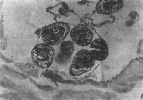肝多房棘球绦虫感染