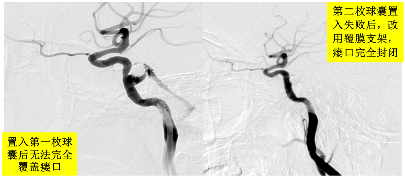 颈内动脉海绵窦瘘