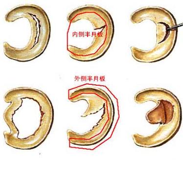  p>盘状半月板又称盘状软骨,是指半月板的形态异常,较正常的半月板大