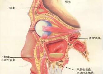 霉菌鼻炎