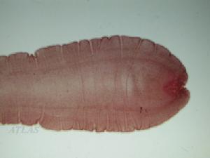 阔节裂头绦虫病