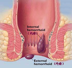  p>外痔位于齿线以下,是由痔外静脉丛曲张或肛缘皱襞皮肤发炎,肥大
