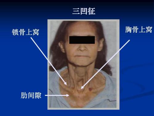  p data-id="2fncysjsz6g">胸骨上窝,是一个重要的体表标志,为胸骨柄