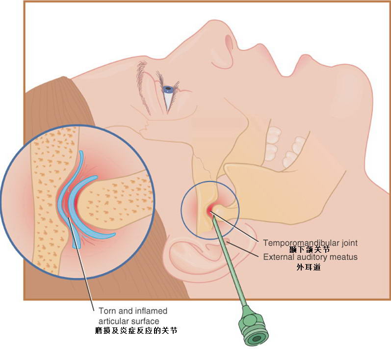 颞下颌关节炎
