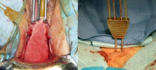  p>耻骨阴道悬吊手术是一种外科手术,主治 a target="_blank" href="