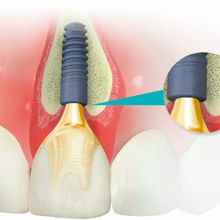  p>ankylos,牙种植系统,逼真地再造天然牙的修复特点.