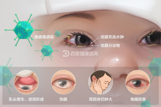 急性结膜炎_百度百科