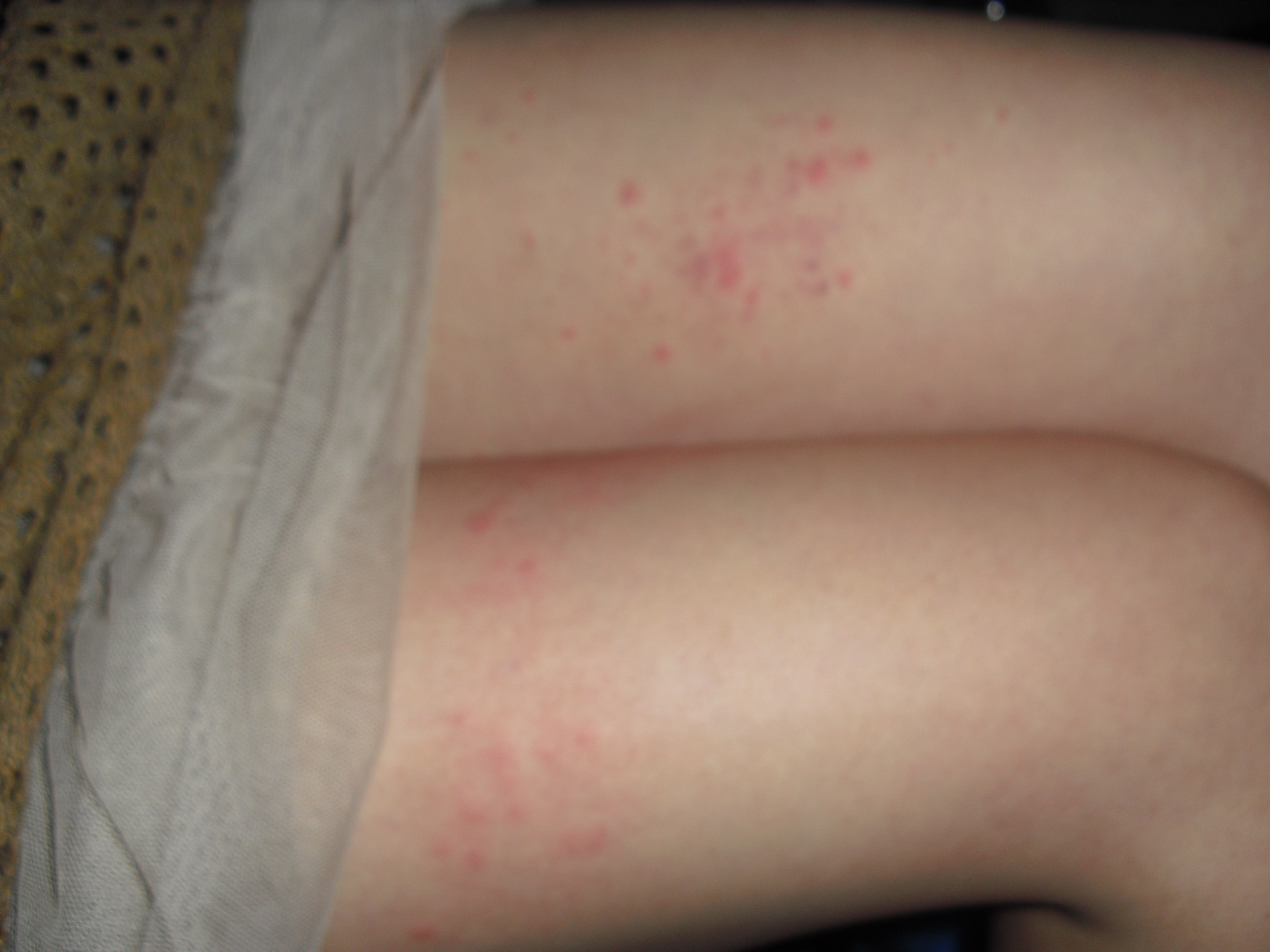 皮肤寄生虫感染