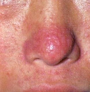  p>畸形鼻是指鼻子产生歪曲,倾斜,缺失,明显不对称等,和常人的鼻子有