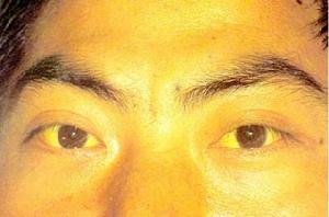 甲哌力复霉素