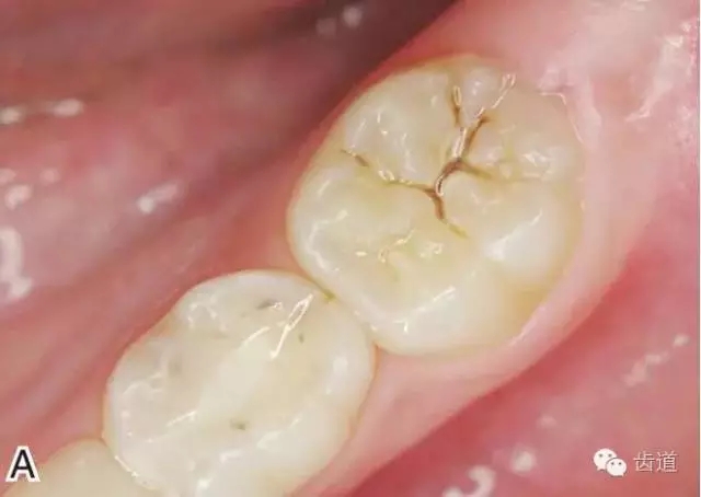 pit and fissure caries