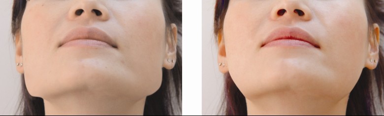 长曲线下颌角整形