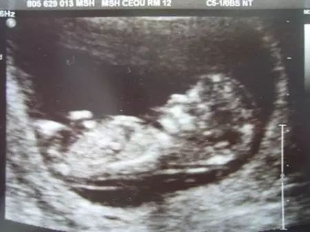 >颈后透明带 /a>扫描",是通过 a target="_blank" href="/item/b超/68