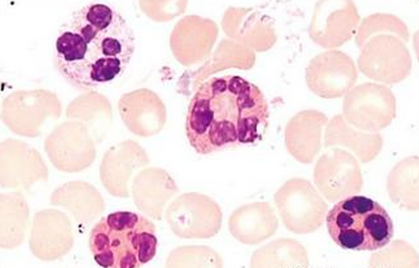 中性白(粒)细胞减少症