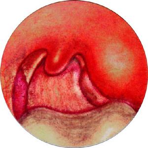 扁桃体周围蜂窝织炎