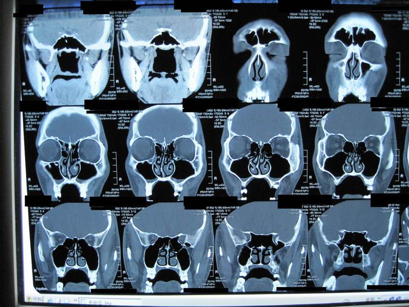 ">鼻窦 /a>冠位病变而做的 a target="_blank" href="/item/ct/122415