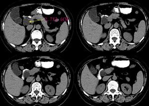  p>侵蚀性葡萄胎(invasivemole)系指葡萄胎组织侵入子宫肌层或有远处