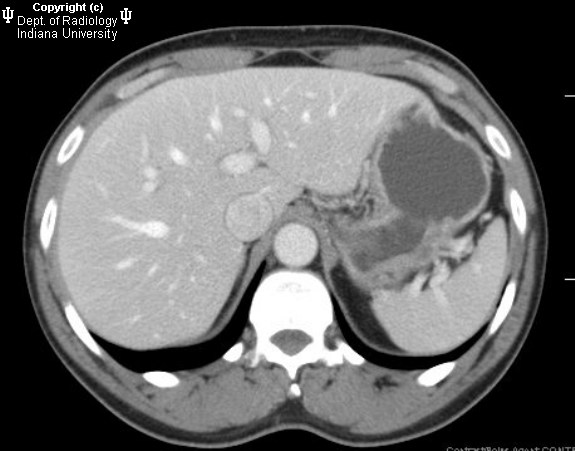  p>胰腺囊腺瘤和囊腺癌,英文名:cystadenoma and cystadenocarcinoma