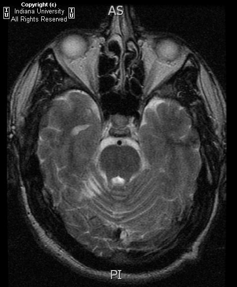 小脑皮质弥漫性神经节细胞瘤