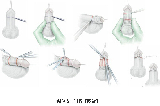 href="/item/包皮/992367" data-lemmaid="992367">包皮 /a>进行切除