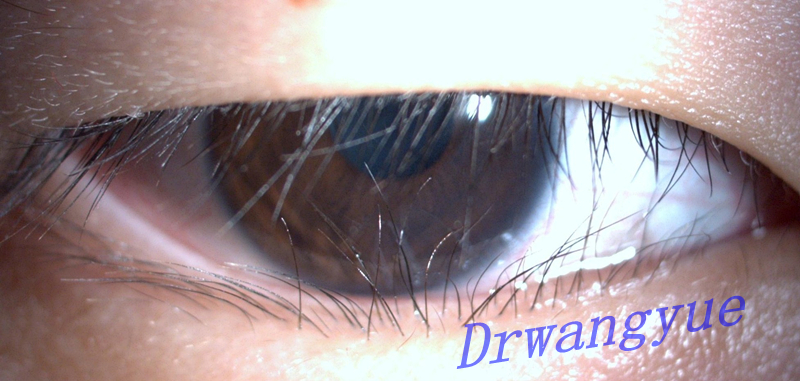  p>倒睫(trichiasis):是指睫毛向后方生长,以致触及眼球的不正常状况.