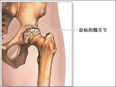 髋关节骨关节炎
