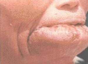 舌(scrotaltongue),裂纹舌(fissuredtongue),沟纹舌(furrowedtongue)