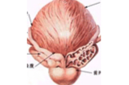 前列腺增生伴钙化石